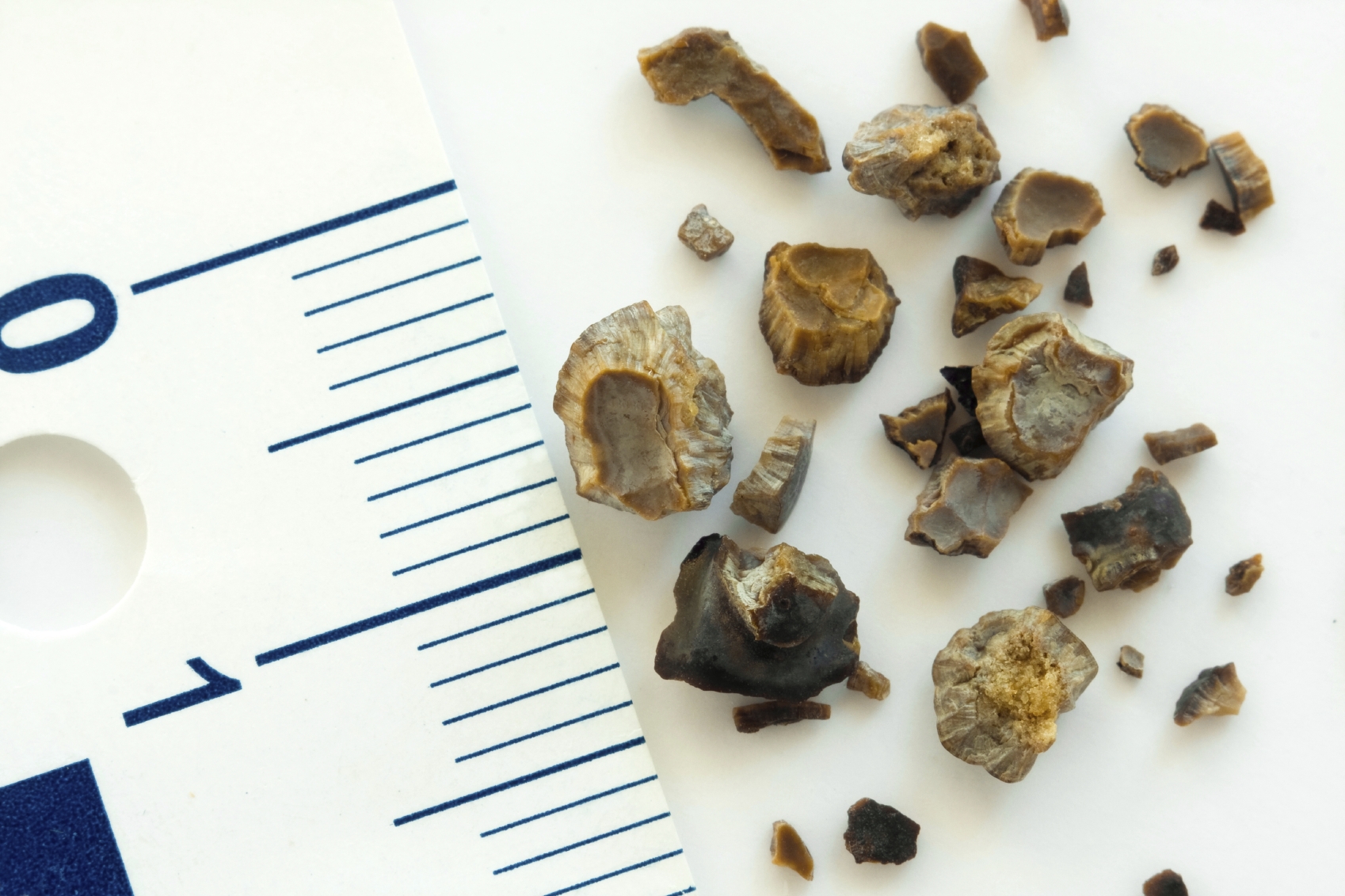 Kidney Stones Are On The Rise Harvard Health Blog Harvard