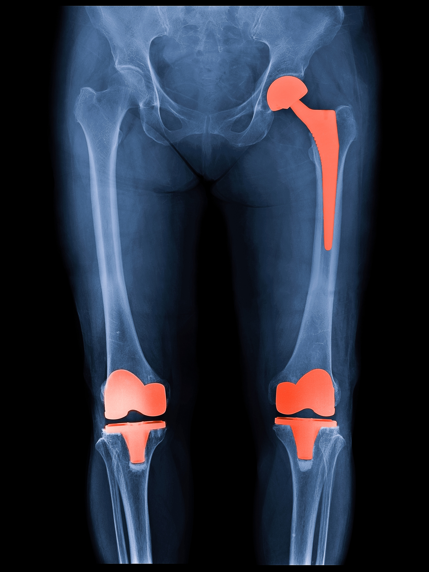 Image result for knee and hip replacement photos