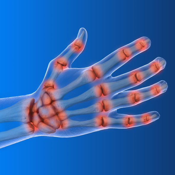 3-D illustration showing inflammation in joints of hand and wrist