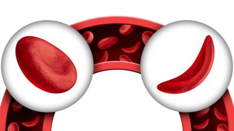 Foreground, a typical red blood cell and a blood cell affected by sickle cell disease; background, normally and abnormally shaped red blood cells in a blood vessel